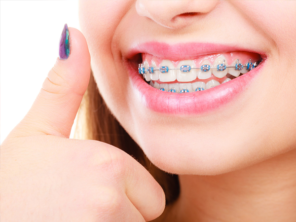 Braces Treatment